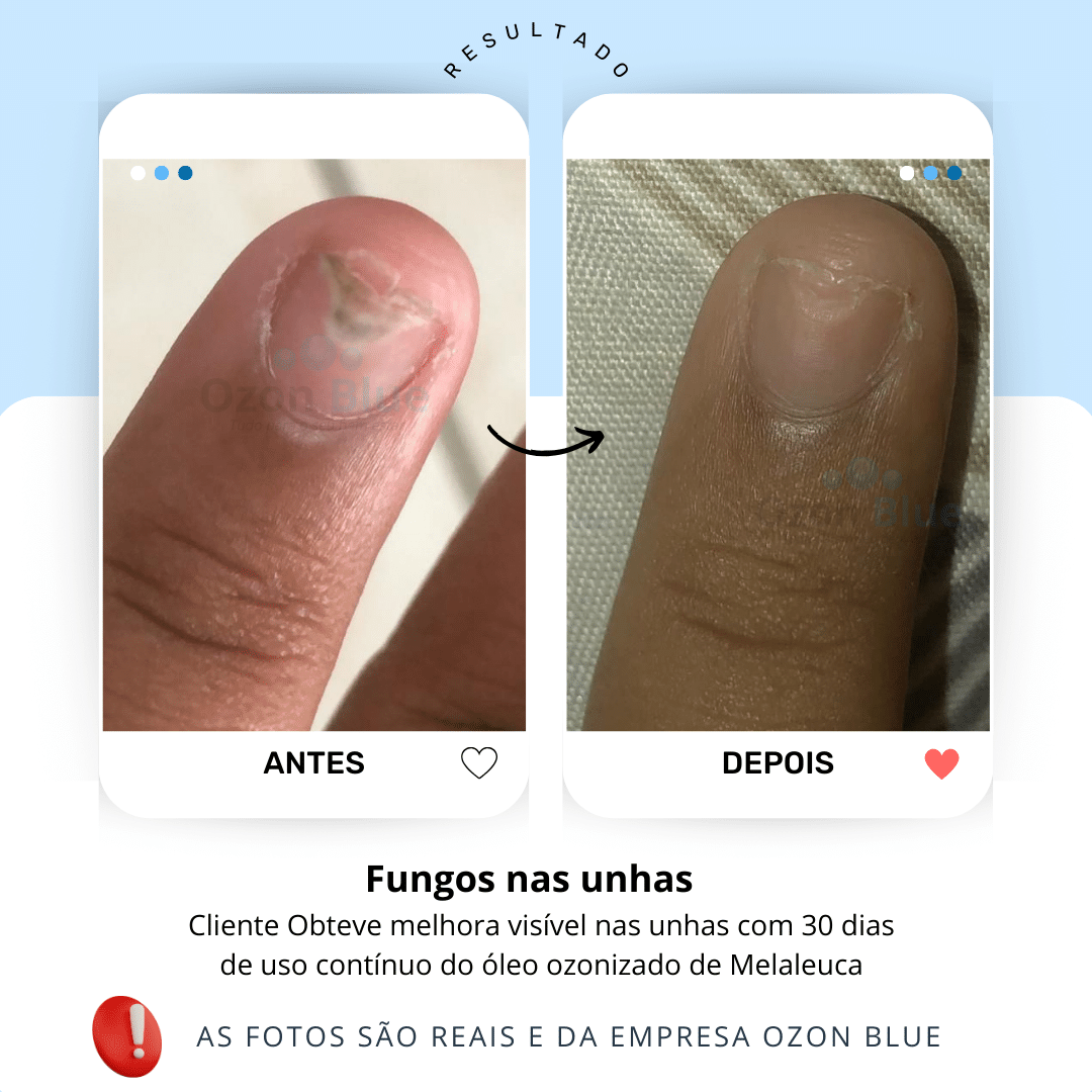 Óleo de Melaleuca Ozonizado - Imagem 5