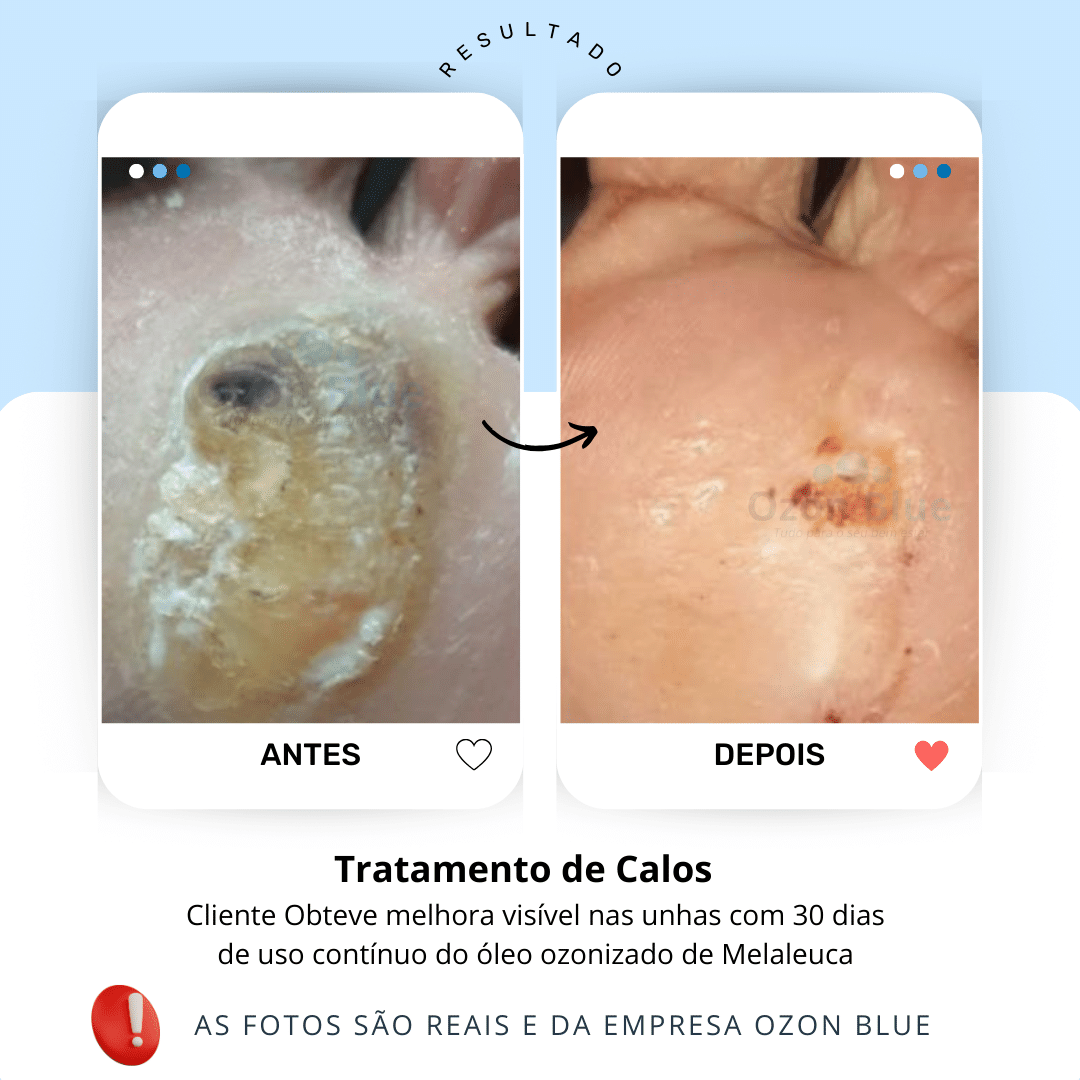 Óleo de Melaleuca Ozonizado - Imagem 4