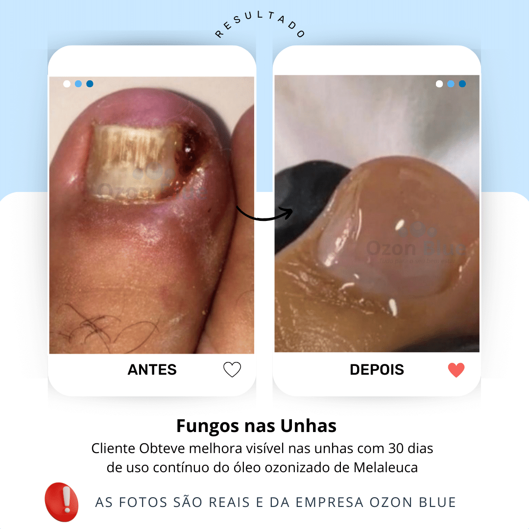 Óleo de Melaleuca Ozonizado - Imagem 2